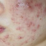 Fungal Acne