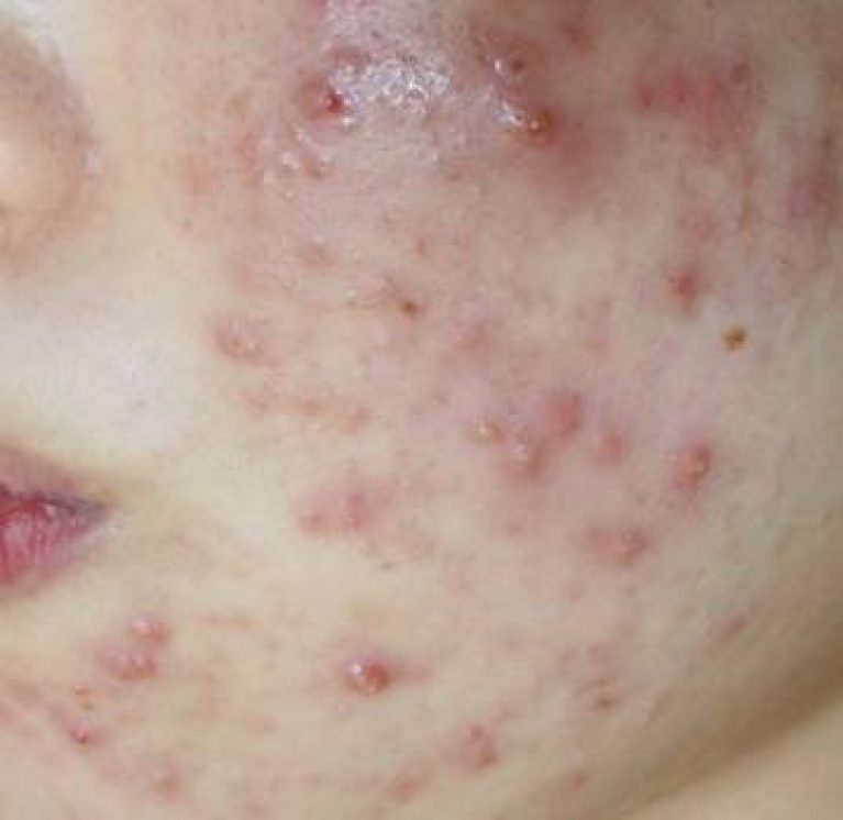 What is Fungal Acne Beauty Supply Reviews