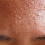 How to Get Rid of Fungal Acne