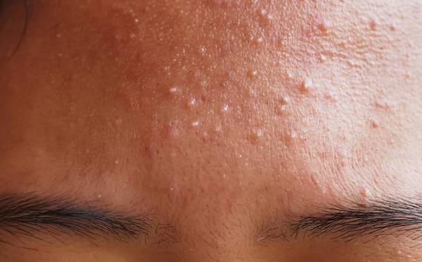 How to Get Rid of Fungal Acne