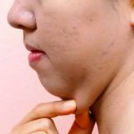 How to Lose Chin Fat