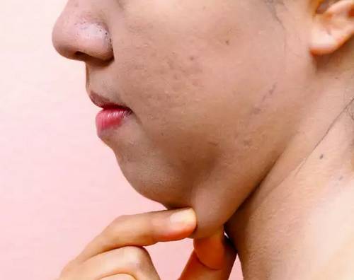 How to Lose Chin Fat