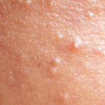 What Does Fungal Acne Look Like