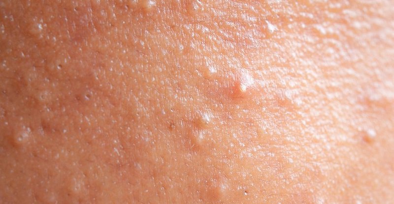 What Does Fungal Acne Look Like