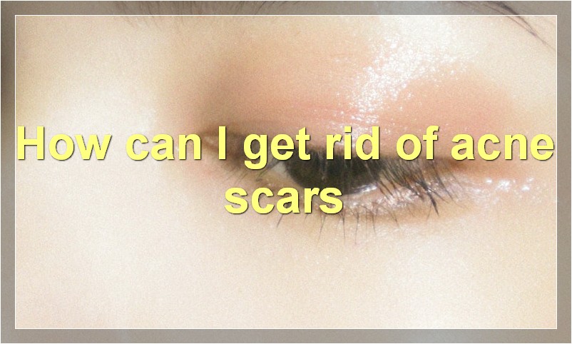 How can I get rid of acne scars