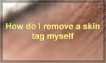 How do I remove a skin tag myself
