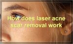 How does laser acne scar removal work