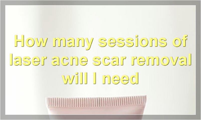 How many sessions of laser acne scar removal will I need
