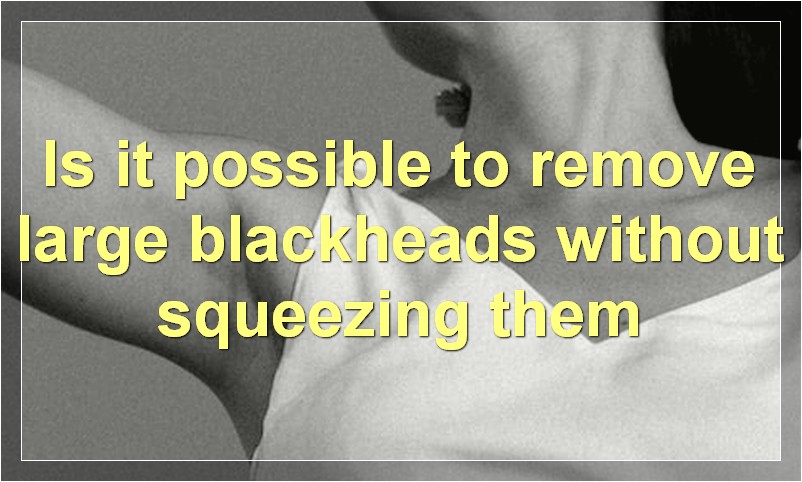 Is it possible to remove large blackheads without squeezing them