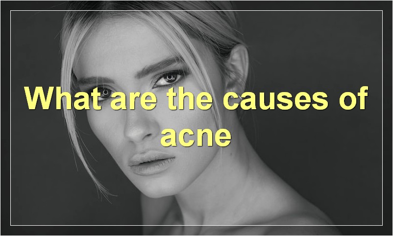 What are the causes of acne