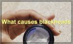 What causes blackheads