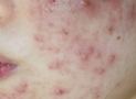 What is Fungal Acne