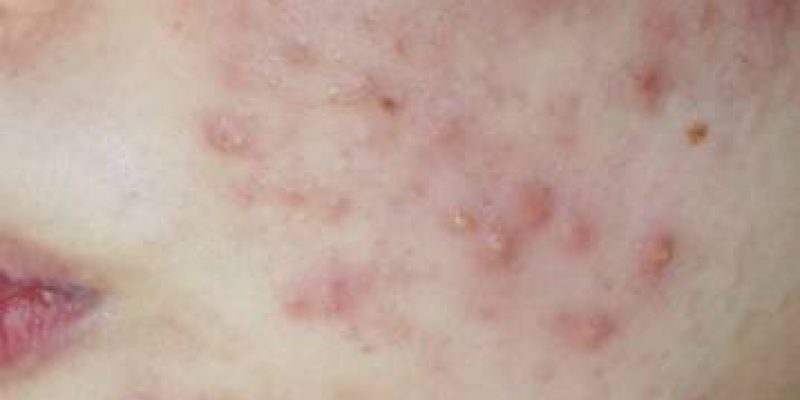 What is Fungal Acne