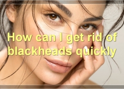 How To Remove Blackheads: The Ultimate Guide