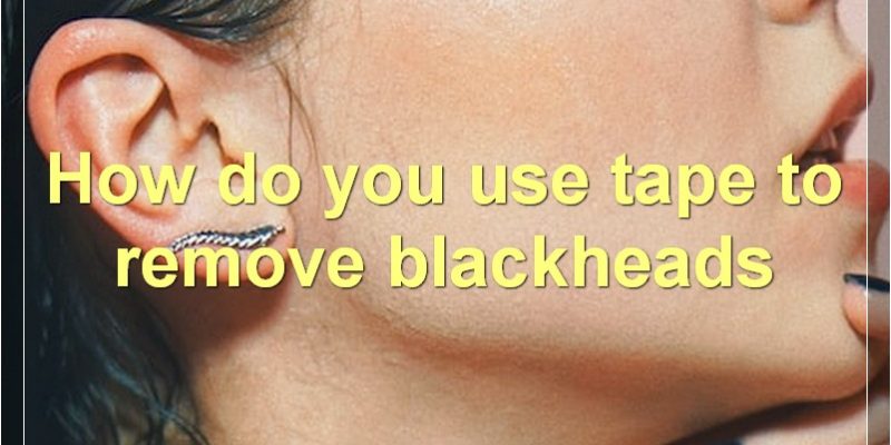 How To Remove Blackheads With Tape: The Complete Guide