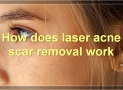 Laser Acne Scar Removal: Everything You Need To Know