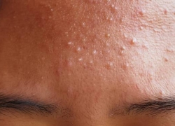 How to Treatment Fungal Acne