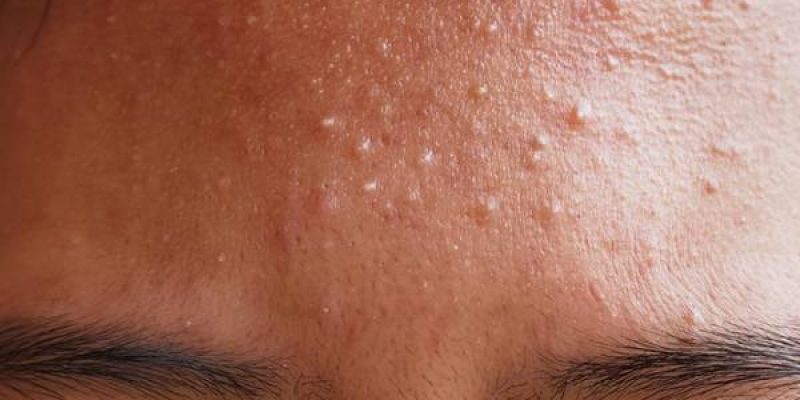 How to Treatment Fungal Acne