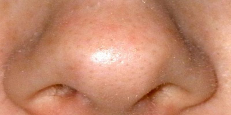 Get Rid of Sebaceous Filaments