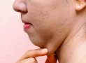 How to Lose Chin Fat