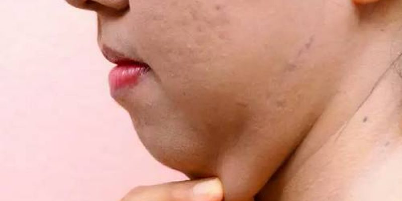 How to Lose Chin Fat