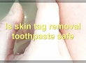 Skin Tag Removal Toothpaste: Everything You Need To Know