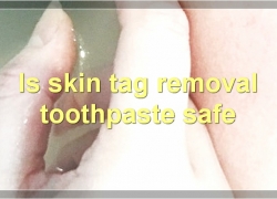 Skin Tag Removal Toothpaste: Everything You Need To Know