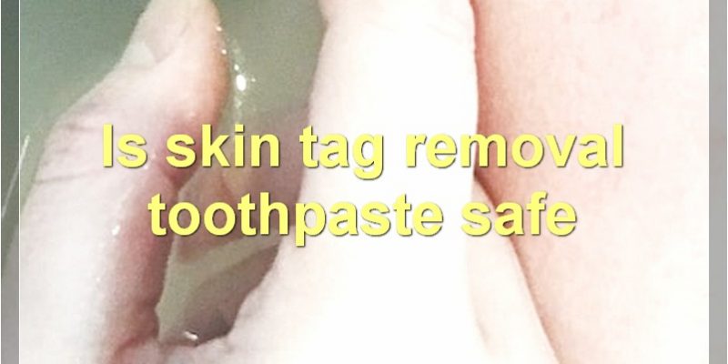 Skin Tag Removal Toothpaste: Everything You Need To Know