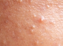 What Does Fungal Acne Look Like?