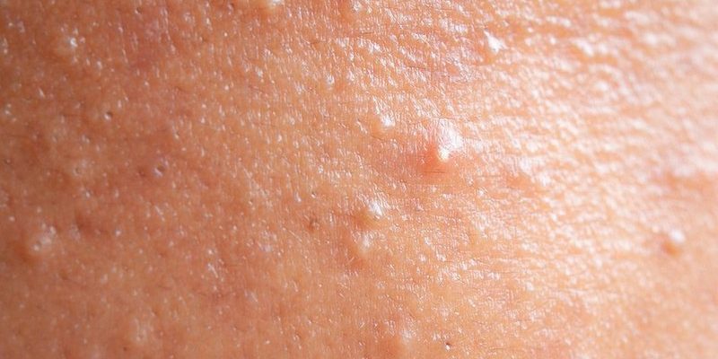 What Does Fungal Acne Look Like?