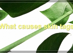 Everything You Need To Know About Skin Tags